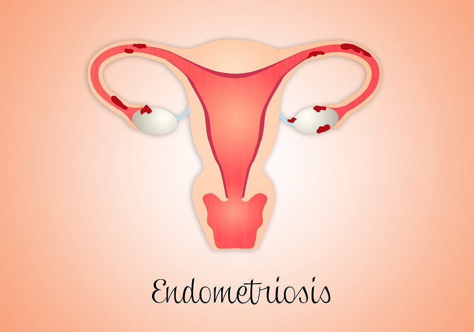 Endometriosi  - Approcci Naturopatici